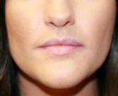 Feel Beautiful - Belotero Lip Augmentation - After Photo